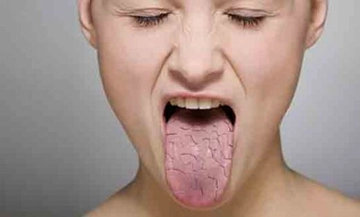 Boğaz Kuruluğu Yutkunma Zorluğu Nasıl Geçer?