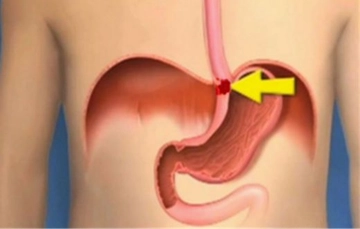 Yutak Borusu Kanseri Belirtileri ve Tedavisi